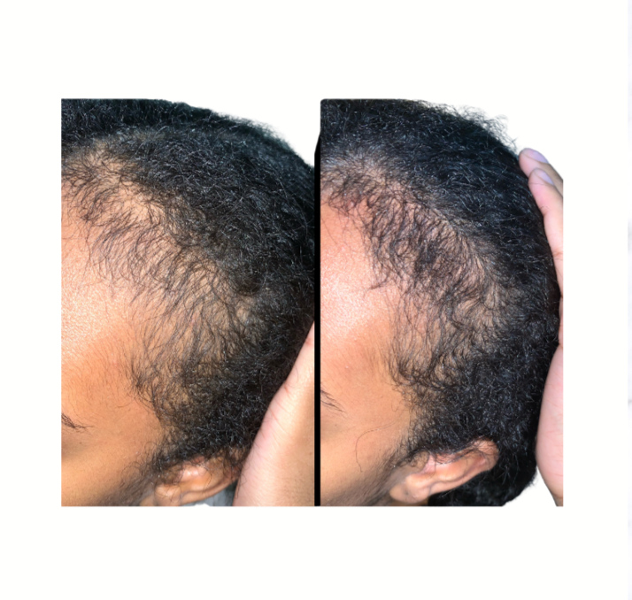 Stimulate Beard  & Hairline Growth Oil